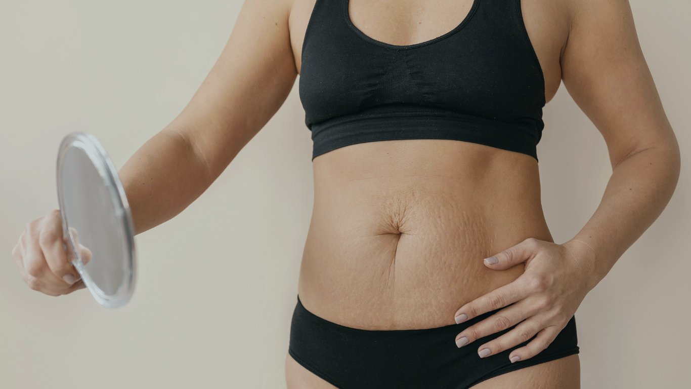 uma mulher de calcinha e top preto, com a mão sobre a barriga que possui diástase, pensando em fazer uma Lipoabdominoplastia com plicatura da diástase
