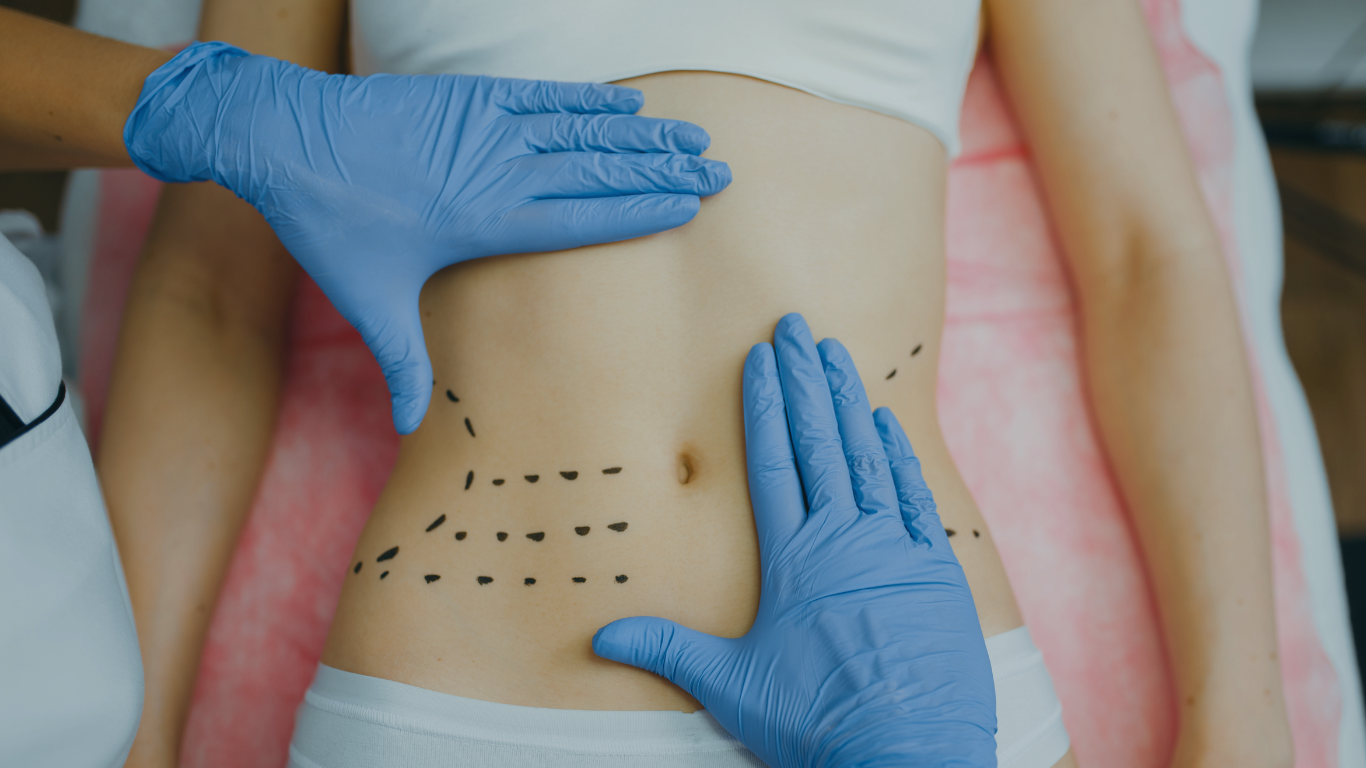 médico com luvas azuis fazendo um exame na barriga de uma mulher que deseja saber o que é a minimally invasive lipoabdominoplasty