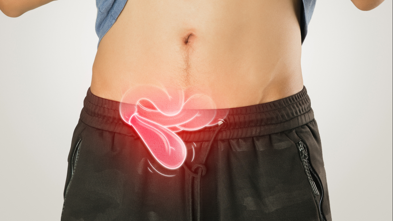 Homem com a camiseta levantada, mostrando hernia inguinal, para falar sobre a cirurgia