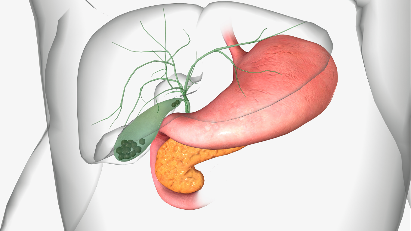 Pedras na vesícula, para falar sobre os riscos